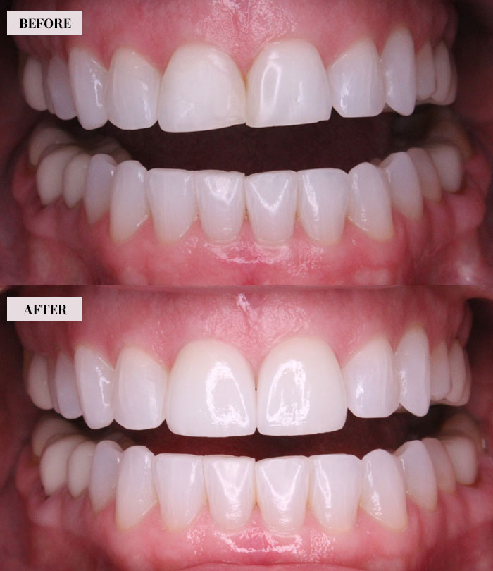 2 Dental Veneers - After Image - Brian Gradinger DMD