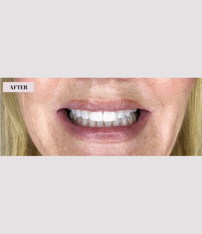 2 Dental Veneers - After Image - Brian Gradinger DMD