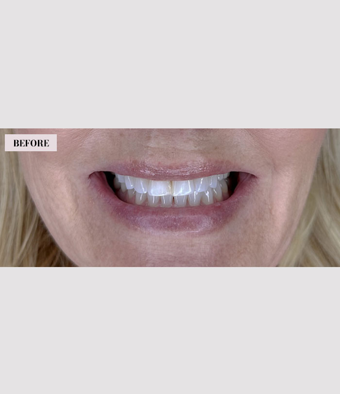 2 Dental Veneers - Before Image - Brian Gradinger DMD